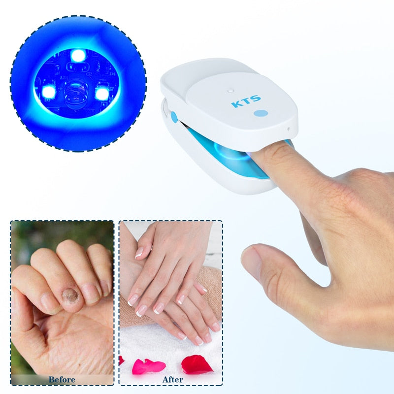 Fungal Nail Treatment Laser Device For Nail Fungus - onestopmegamall23